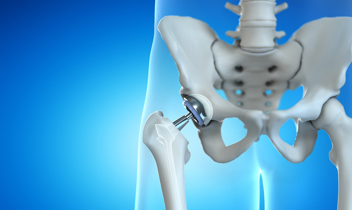 Total Hip Replacement - Anterior Approach