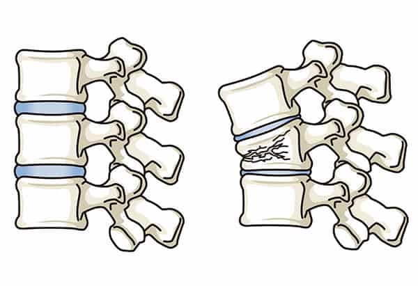 Illustration of healthy spine vs spine with compression fracture