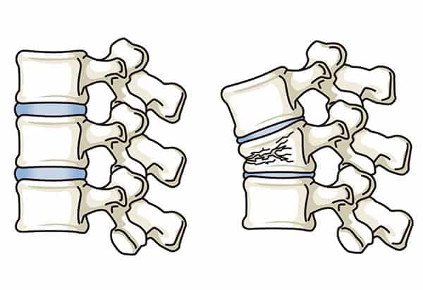 Compression Fractures